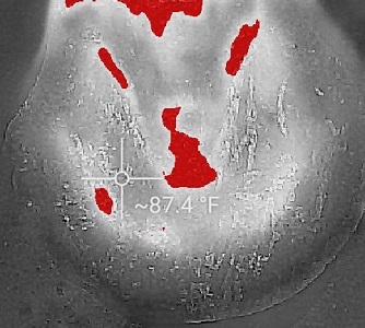 Thermalabscess